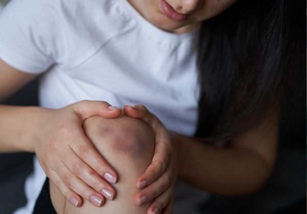 Frau mit Bluterguss auf dem Knie